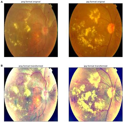 A hybrid neural network approach for classifying diabetic retinopathy subtypes